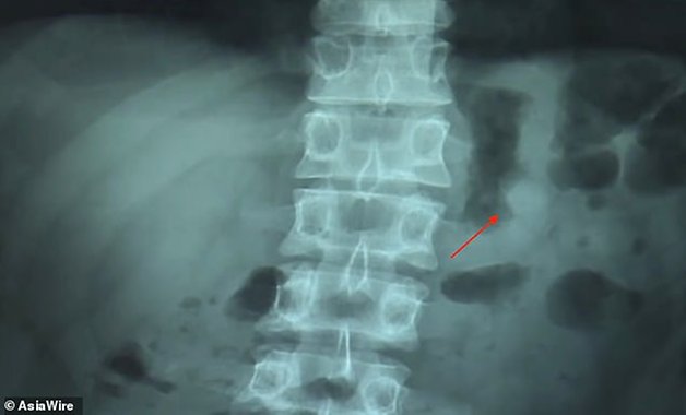 Image 1 : Un homme avale son AirPod et l’entend biper dans son estomac