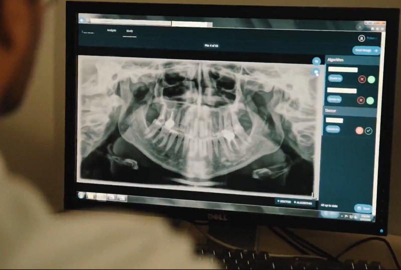Image 1 : Détectez vos caries plus tôt et plus précisément grâce à l’intelligence artificielle