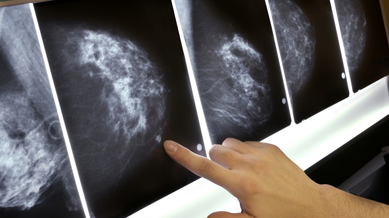 Image 1 : L'IA de Google dépiste mieux le cancer du sein qu'un humain