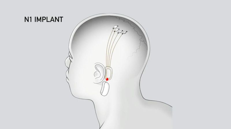elon musk neuralink implant