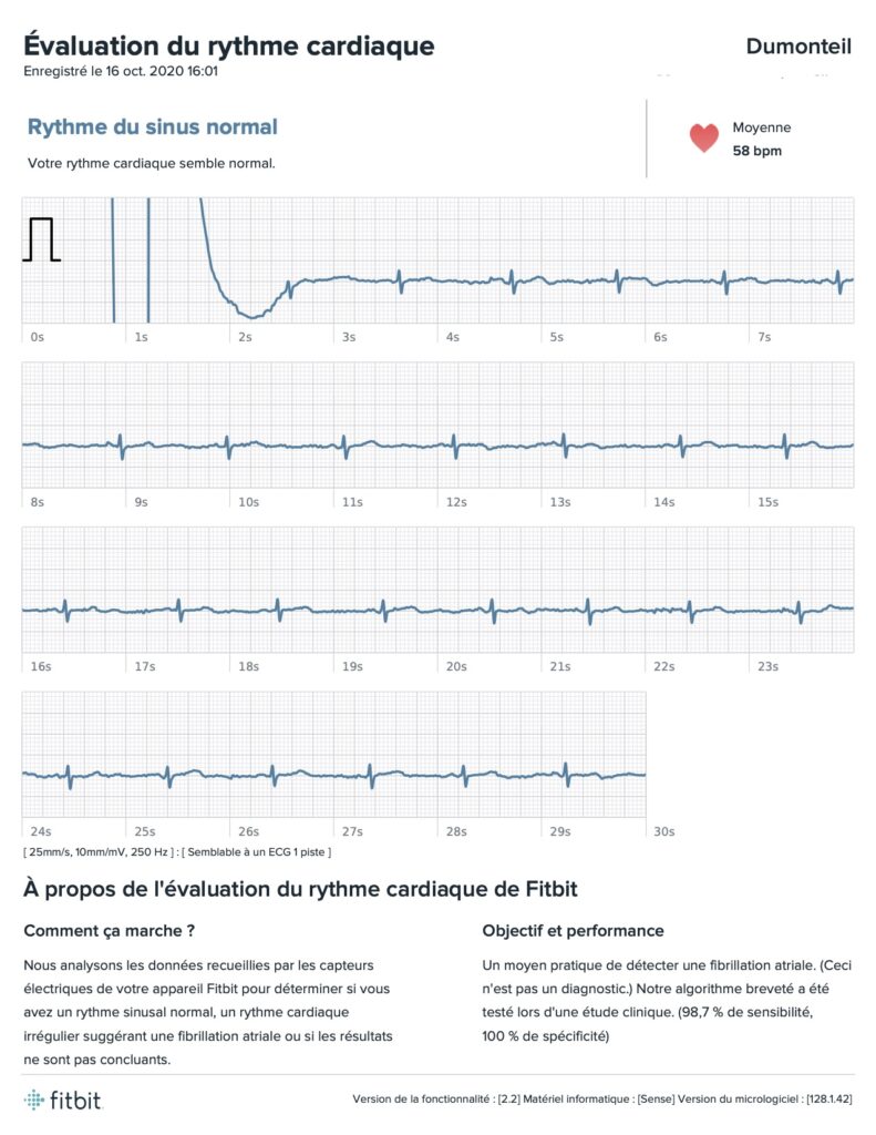 fitbit sense ecg