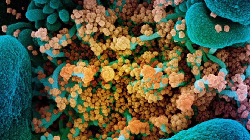 Une cellule mourante (bleue) fortement infectée par des particules virales du SARS-CoV-2 (jaune)