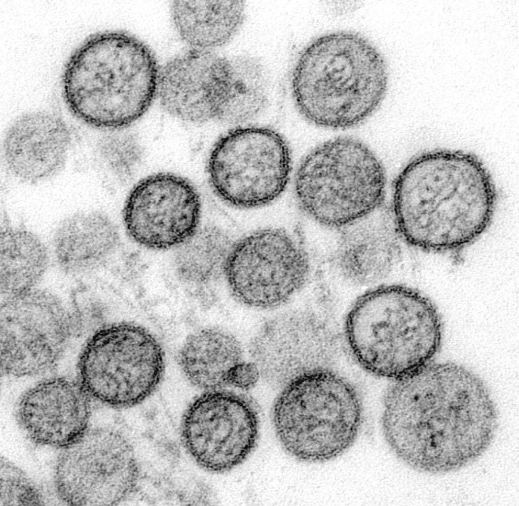 Image 6 : Grippe, Covid-19, Variole..., les virus les plus mortels de l’Histoire